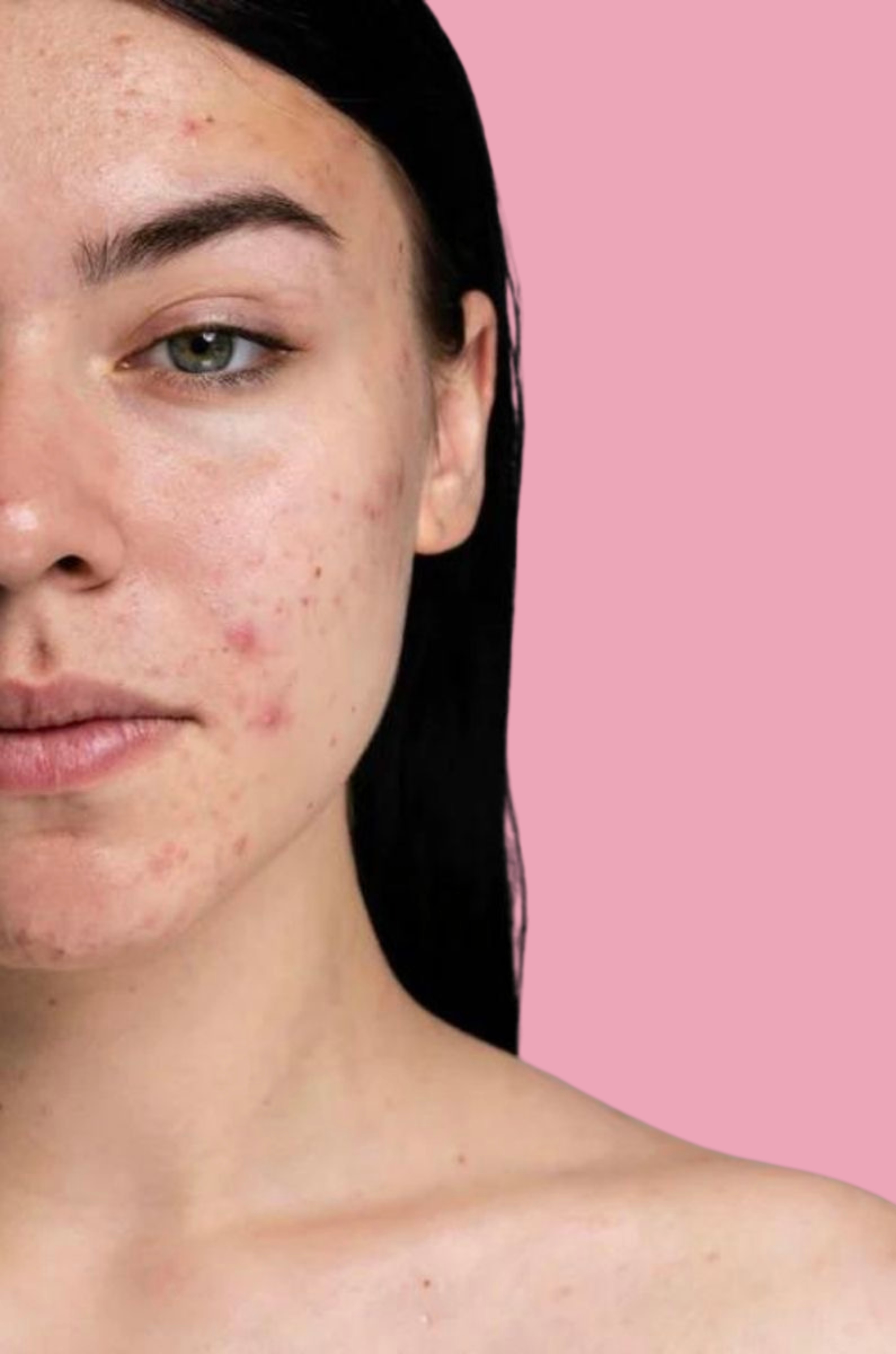 Korean Skincare for Acne and Pimples - Acne Patches, Pimple Serums, and Treatment Gels to Clear Skin, Reduce Breakouts, and Control Oil