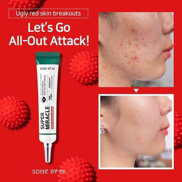 Some By Mi AHA BHA PHA 14 Days Super Miracle Spot All Kill Cream – Before and after showing reduced blemishes, clearer skin, and a smoother complexion.