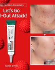 Some By Mi AHA BHA PHA 14 Days Super Miracle Spot All Kill Cream – Before and after showing reduced blemishes, clearer skin, and a smoother complexion.