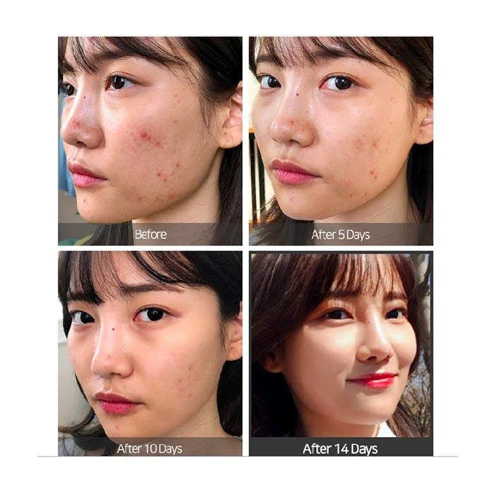 Some By Mi AHA BHA PHA 14 Days Super Miracle Spot All Kill Cream – Before and after showing reduced blemishes, clearer skin, and a smoother complexion.