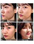 Some By Mi AHA BHA PHA 14 Days Super Miracle Spot All Kill Cream – Before and after showing reduced blemishes, clearer skin, and a smoother complexion.