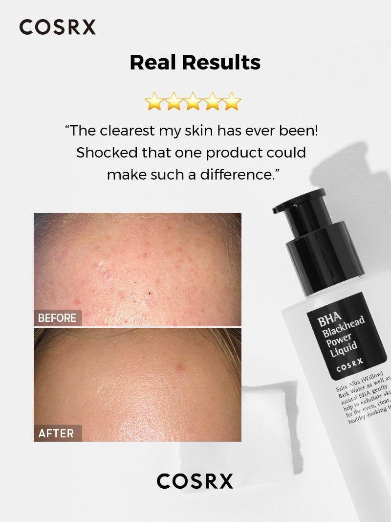 Before and after using Cosrx BHA Blackhead Power Liquid – Reduced blackheads and smoother skin texture for a clearer complexion
