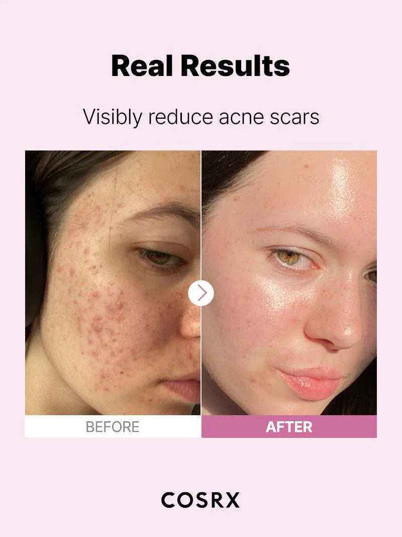 Applying COSRX Niacinamide 15 Serum – reduces dark spots, balances oil, and helps smooth rough skin for a clearer complexion