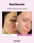 Applying COSRX Niacinamide 15 Serum – reduces dark spots, balances oil, and helps smooth rough skin for a clearer complexion