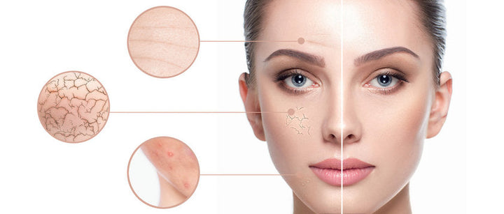 acne, pimple, dark spot, blackhead, whitehead, pigmentation, wrinkles 